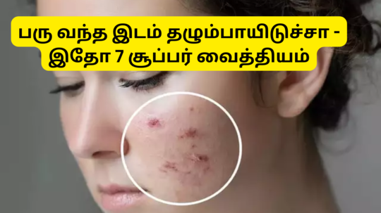 Effective Remedies For Acne Scars : பரு வந்து தழும்பாயிடுச்சா - அந்த வடுக்களை வேகமா மறைய வைக்க 7 சூப்பர் டிப்ஸ் இருக்கே