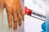 दिल्ली आया Monkeypox, अस्पताल में भर्ती मरीज में दिखे ये 2 लक्षण, WHO ने बताया दुनिया की सबसे घातक बीमारी