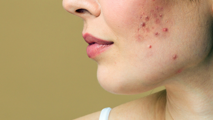 पहले जान लेते हैं कि मुंहासे (Acne) क्यों होते हैं?