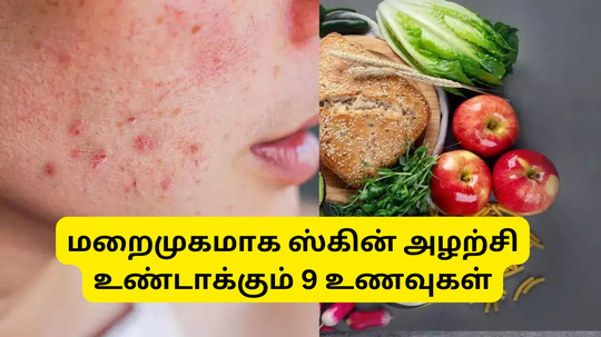 Skin Allergy Stimulating Foods : இந்த 9 உணவுகள் மறைமுகமாக ஸ்கின் அழற்சியை உண்டாக்கும் - கவனமா சாப்பிடுங்க