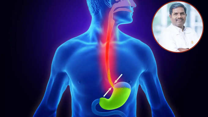 gastroesophageal reflux disease என்னும் இரைப்பை உணவுக்குழாய் ரிஃப்ளக்ஸ் நோய் என்றால் என்ன?