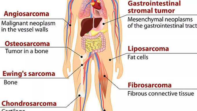 सारकोमा के लक्षण और प्रकार