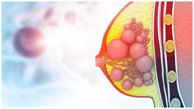 ಬ್ರೆಸ್ಟ್ ಅಥವಾ ಸ್ತನ ಕ್ಯಾನ್ಸರ್