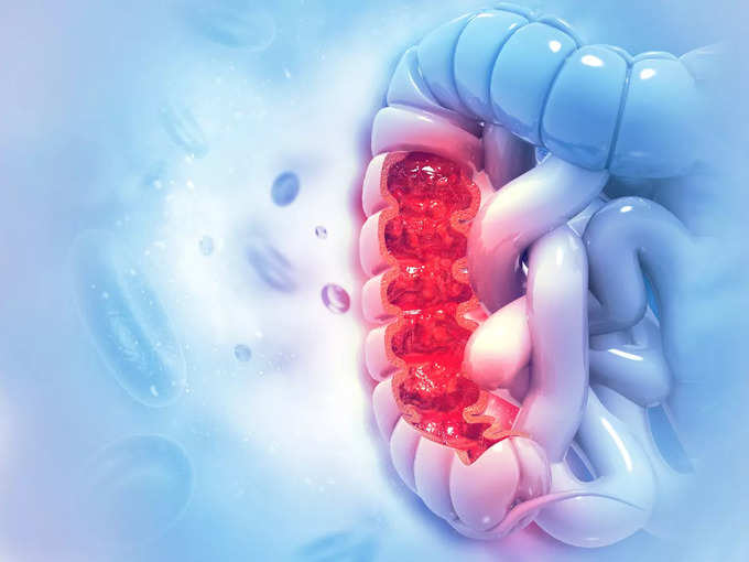 कोलन या कोलोरेक्टल कैंसर के रेड सिग्नल