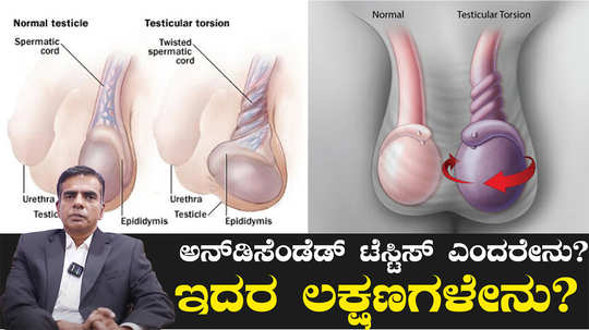 undescended testiclesymptoms and causes