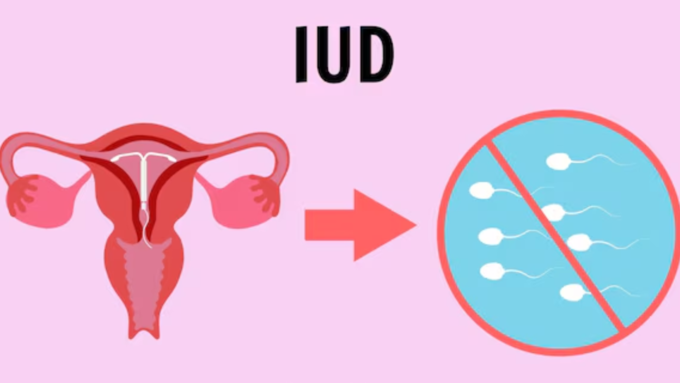 IUD क्या है?