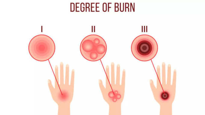 बर्न की गंभीरता को कैसे समझें? 