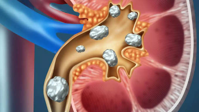 కిడ్నీలో రాళ్లు..
