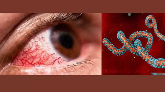 Bleeding eye Virus: கண்கள், மூக்கு, வாய் வழியாக வழியும் ரத்தம்.. மனித குலத்தை மிரட்டும் மார்பர்க் வைரஸ்.. 15 பேர் பலி!