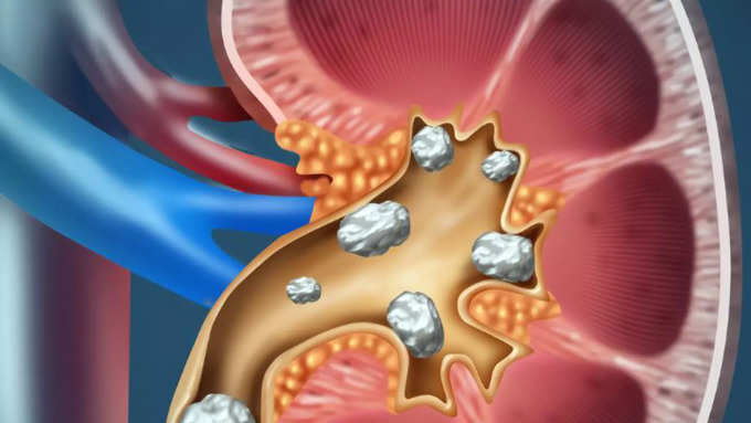 కిడ్నీలో రాళ్లు..