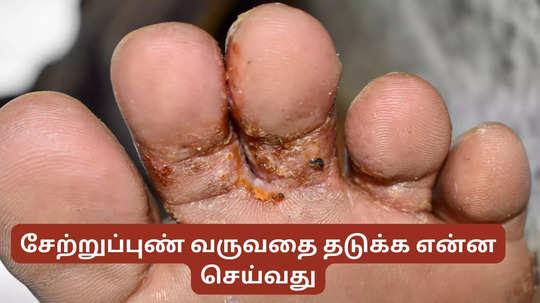 சேற்றுப்புண்:  இந்த 5 விஷயங்கள்ல மட்டும் கவனமா இருங்க, சேற்றுப்புண் வர்றதை தடுக்கலாம்!