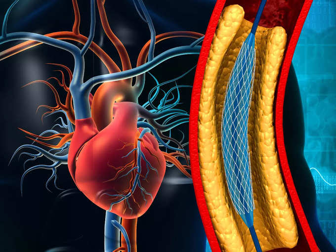 हार्ट स्टेंट की नौबत से बचाएगा