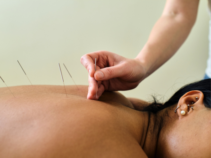 acupuncture needle therapy4