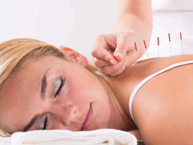 acupuncture needle therapy3