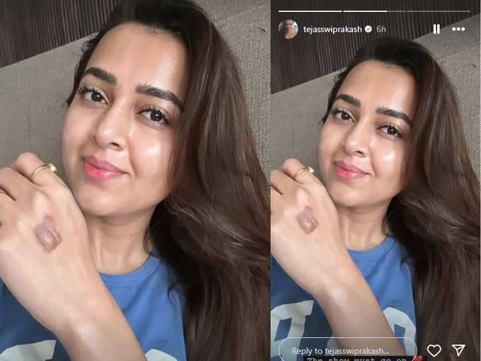 tejasswi-prakash-burnt-hand