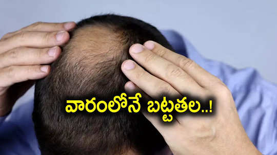 Hair Loss: వారం రోజుల్లోనే బట్టతల.. జుట్టురాలే సమస్యతో బాధపడుతున్న ఆ 3 గ్రామాలు, కారణం అదేనా..?