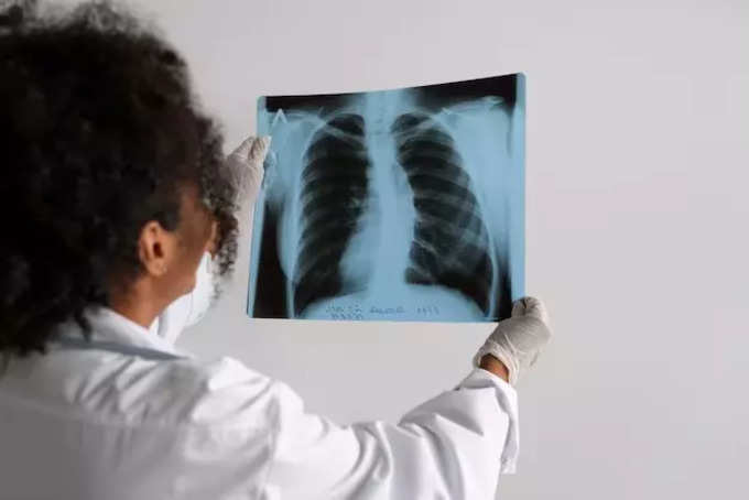 लंग कैंसर (Lung Cancer)