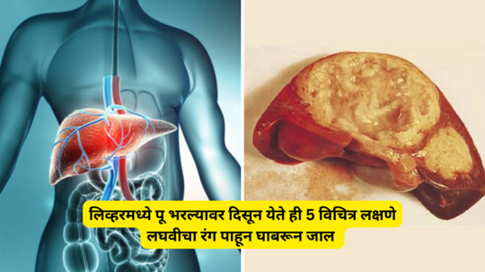 लिव्हरमध्ये पू भरल्यावर दिसून येते ही 5 विचित्र लक्षणे, लघवीचा रंग पाहून घाबरून जाल