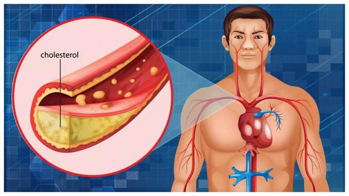 हाई कोलेस्ट्रॉल के लिए जिम्मेदार
