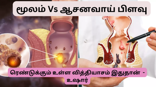 மூலநோய் - ஆசனவாய் பிளவு வித்தியாசம் என்ன? அறிகுறிகள் எப்படி இருக்கும்?