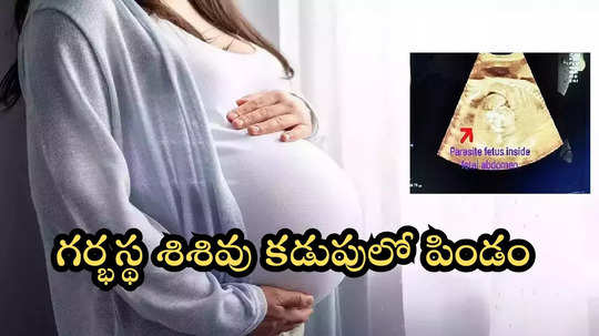 మహిళ గర్భంలో ఉన్న శిశువు కడుపులో పిండం.. మహారాష్ట్ర వైద్యుల మతిపోగొట్టిన ఈ కేసు ఏంటి?