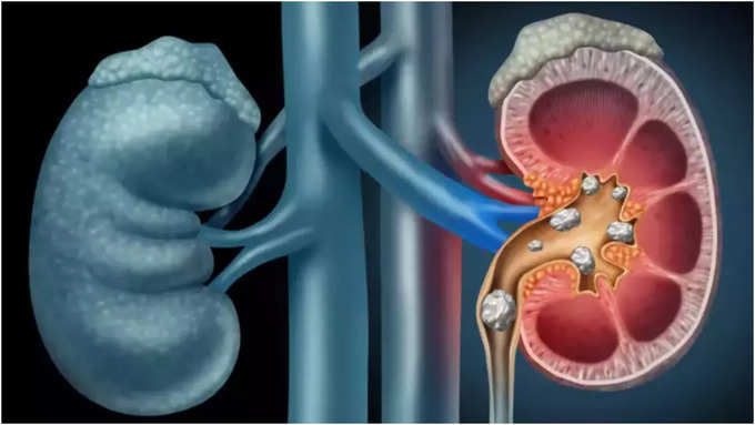 ಮೂತ್ರಪಿಂಡದ ಕಲ್ಲುಗಳಿಗೆ ಚಿಕಿತ್ಸೆ ಏನು?