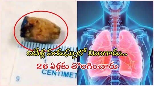 HYD: 21 ఏళ్లుగా ఊపిరితిత్తుల్లోనే పెన్‌ క్యాప్‌.. తొలగించిన కొండాపూర్ కిమ్స్‌ డాక్టర్లు