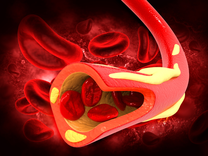 आर्टरी में प्लाक जमने का कारण