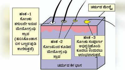 ತಲೆಹೊಟ್ಟಿನ ಸಮಸ್ಯೆ ಅದಾಗಿಯೇ ಹೋಗಲ್ಲ