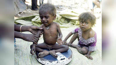 गुजरात में 1.45 लाख बच्चे घोर कुपोषण का शिकार
