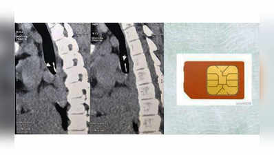 गलती से निगल गईं सिम कार्ड, रिस्की ऑपरेशन से बची जान