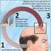 Discover more than 85 hair transplant meaning in hindi