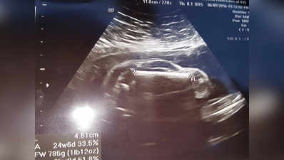 गर्भवती महिला का अल्ट्रासाउंड: स्पोर्ट्स कार जैसा दिखता है भ्रूण!