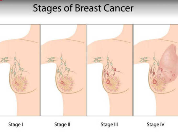 ब्रेस्ट कैंसर पता लगाने के 5 तरीके