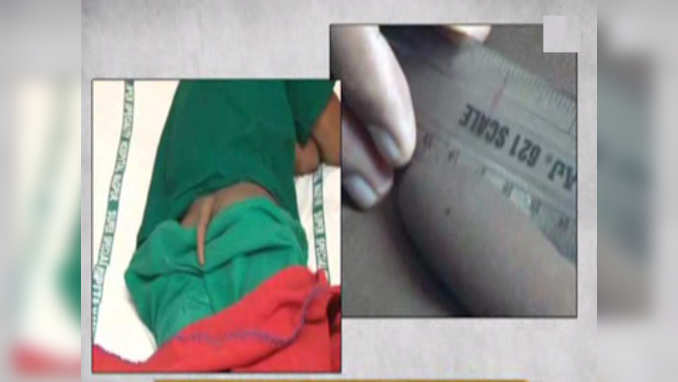 18cm long human tail removed surgically from 18-year-old boy 