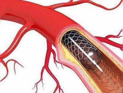 स्टेंट की कीमत अपनी वेबसाइट्स पर डालें अस्पताल: एनपीपीए