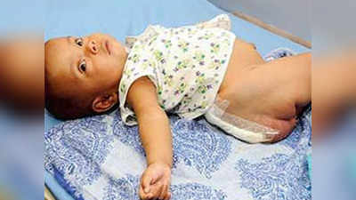 डॉक्टरों ने 4 माह की बच्ची के शरीर से निकाले 4 बेकार हिस्से