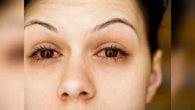 मॉनसून के सीजन में आंखें लाल मतलब कंजंक्टिवाइटिस का खतरा