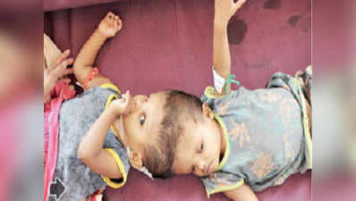 देश में पहली बार: सिर से जुड़े बच्चों को अलग करने की सर्जरी सफल, आईसीयू में शिफ्ट