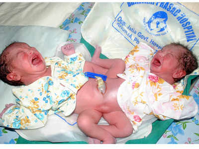 पेट से जुड़े जुड़वा बच्चों का जन्म