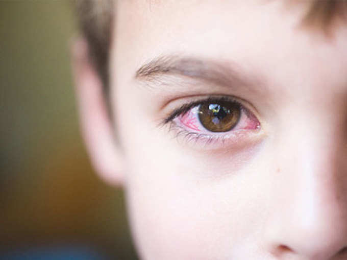 आंखों में संक्रमण का खतरा