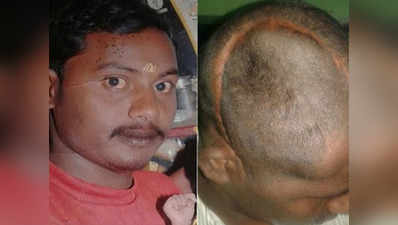 कर्नाटक: सर्जरी के बाद मरीज के सिर का एक हिस्सा गायब
