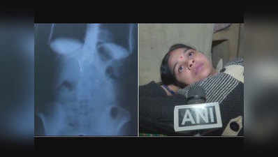वाराणसी: लापरवाह डॉक्टर ने ऑपरेशन में पेट के अंदर ही छोड़ दी सुइयां, शिकायत दर्ज