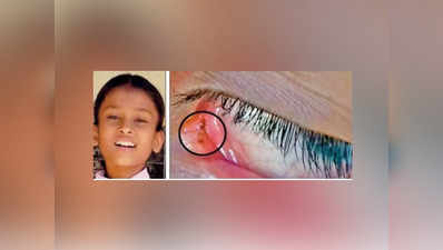 11 साल की बच्ची की आंख से निकलती हैं चीटियां, डॉक्टर भी हैरान