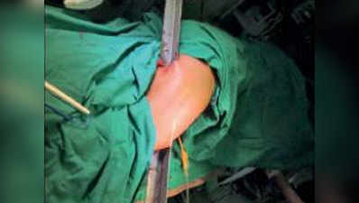 मुंबई: जांघ के आर-पार हो गया था सरिया, च‍िक‍ित्‍सकों ने बचाई जान