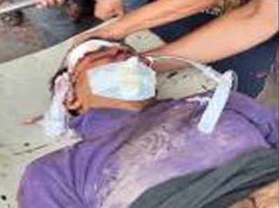 आगराः बंदरों ने किया हमला, सेकंड फ्लोर से गिरा MBBS छात्र, हालत गंभीर
