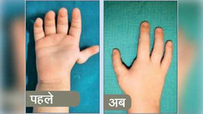 रेयर सर्जरी: उंगली को बना दिया अंगूठा