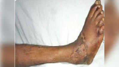 मुंबईः छह घंटे तक चली सर्जरी, जोड़ दिया कटा हुआ पैर