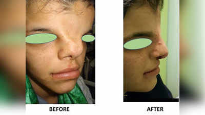 सर्जरी से हटाई 2 नाक, फिर लगाई नई नाक