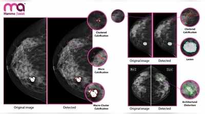 Mammo Assist: ಸ್ತನ ಕ್ಯಾನ್ಸರ್ ಆರಂಭಿಕ ಹಂತ ಪತ್ತೆಗೆ ಎಐ ಆಧರಿತ ತಂತ್ರಾಂಶ